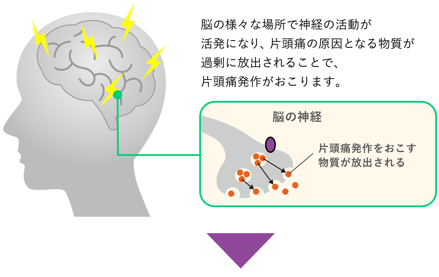 片頭痛発作時の脳の状態